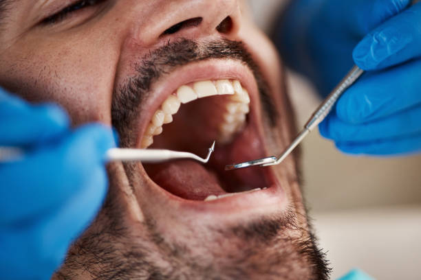 Best Emergency Dentist for Lost Fillings or Crowns in San Gabriel, CA