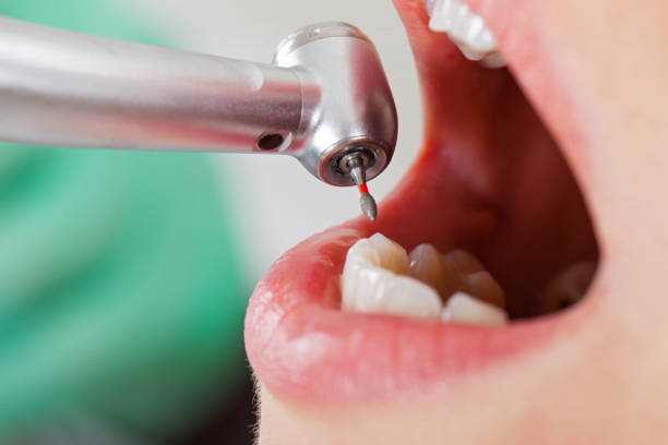 Best Emergency Dental Care for Abscessed Tooth in San Gabriel, CA